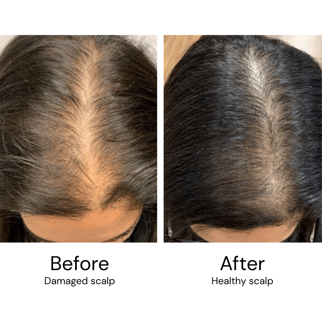 VitalHair Scalp Massager (+2 FREE Gifts)